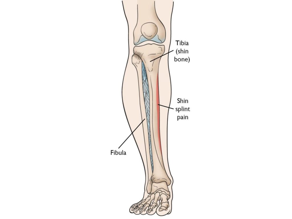 Shin Splints Bone Look Shin Splints - Podiatry Quest