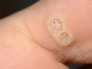 foot warts