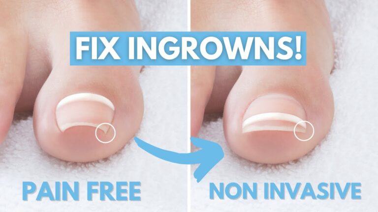Picture of Ingrown Toenail: Tips from a Podiatrist to Prevent Ingrown Toenails