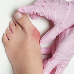 bunion