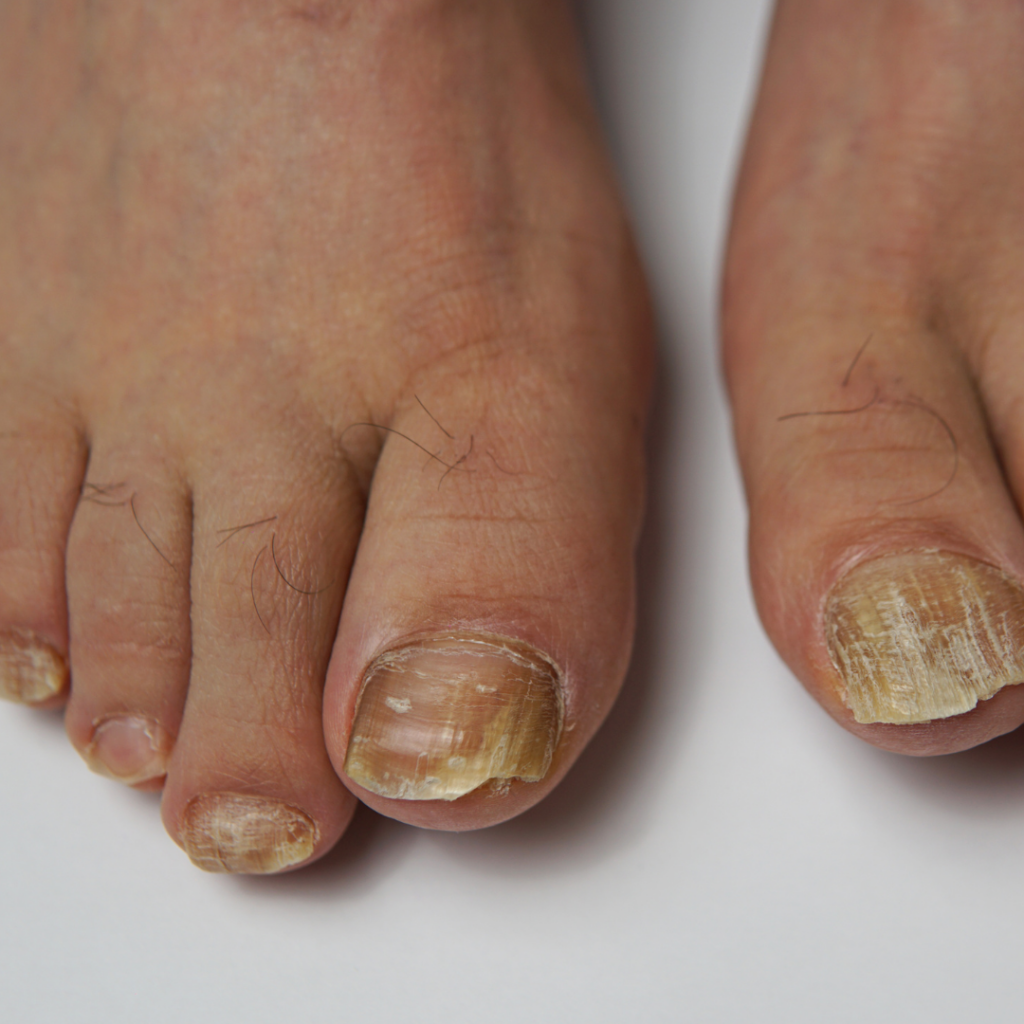 fungal toenail pact therapy