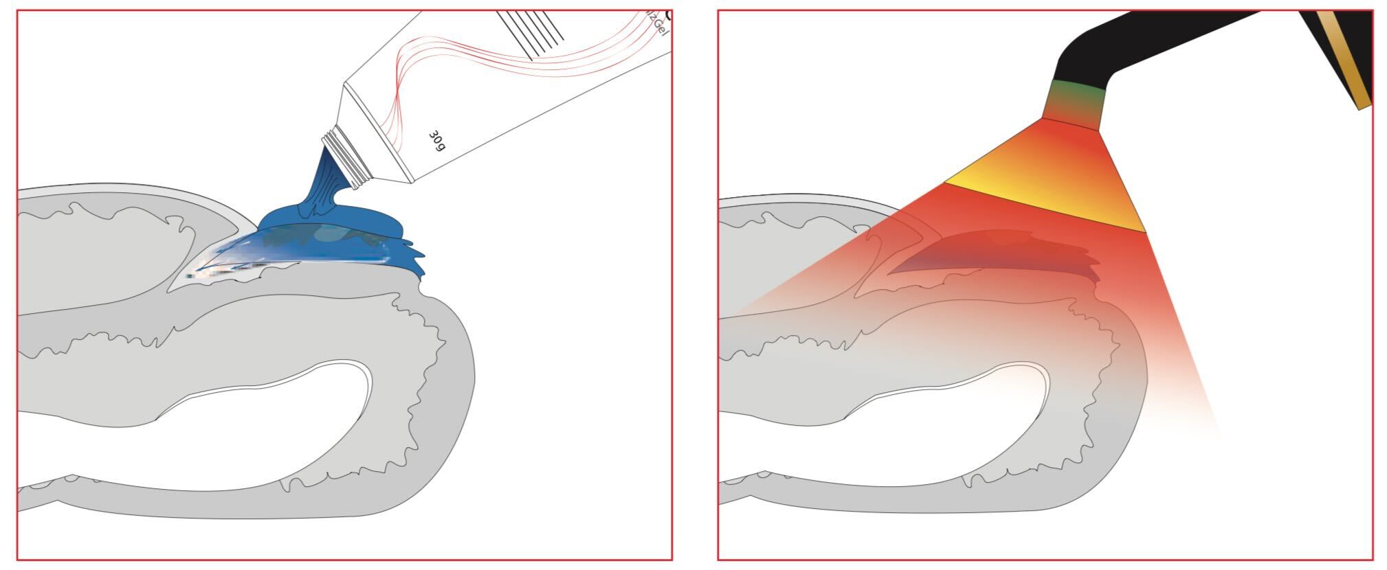 fungal toenail pact therapy