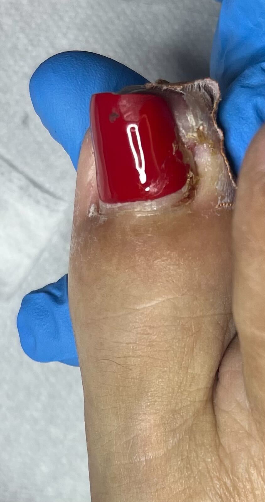 Infected Ingrown Toenail Treatment Singapore: When to Get Help