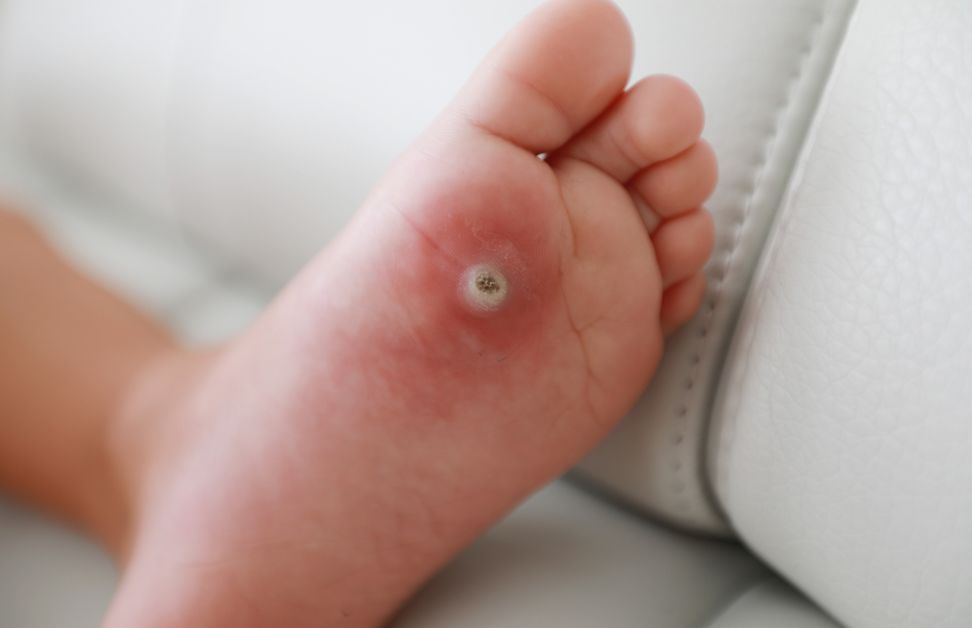 Foot Warts Removal in Singapore: Why OTC Treatments Keep Failing (Raffles Place Guide)