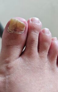 fungal toenail